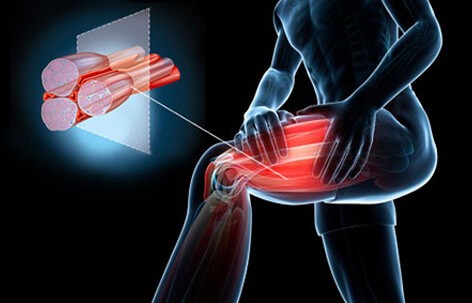 intindere musculara vs ruptura rănile și arsurile articulare