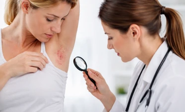 Hidradenita supurativa