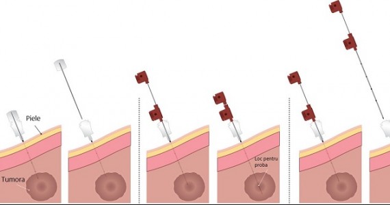 punctie perc ONCOFORT