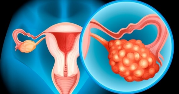 cancerul ovarian OncoFort