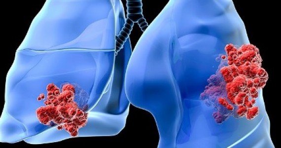 prezentare caz cancer pulmonar gral