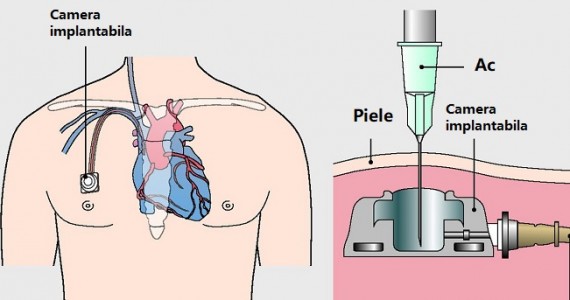 camera-implantabila-gralmedical