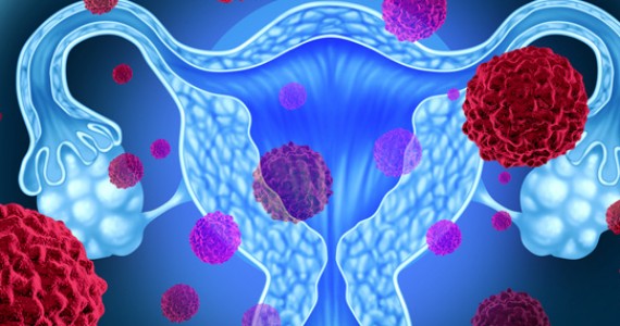 cancer col uterin site