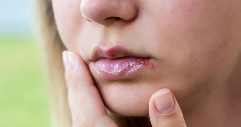 cheilita angulara tratament