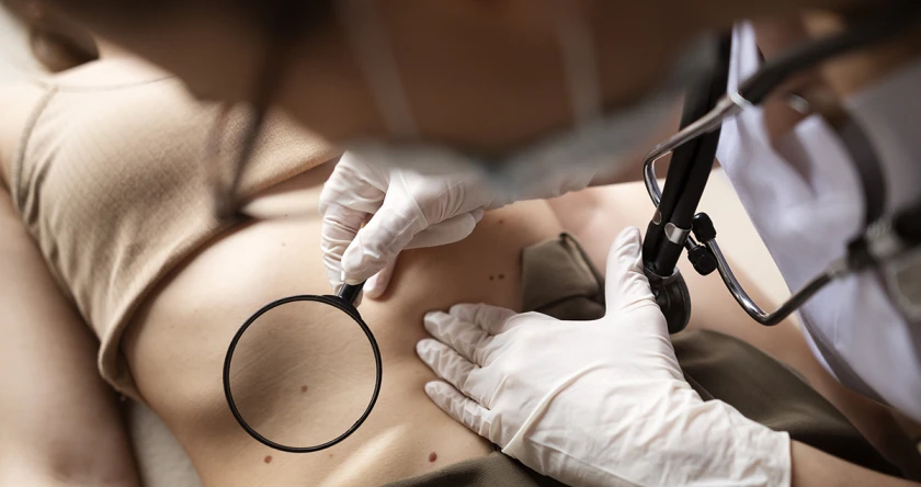 Evaluare dermatoscopică alunite