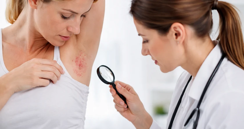 Hidradenita supurativa