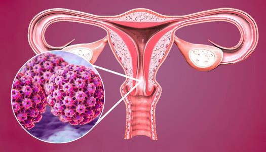 Infectia HPV Gral Medical